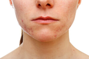 Causes of acne under the chin and jaw