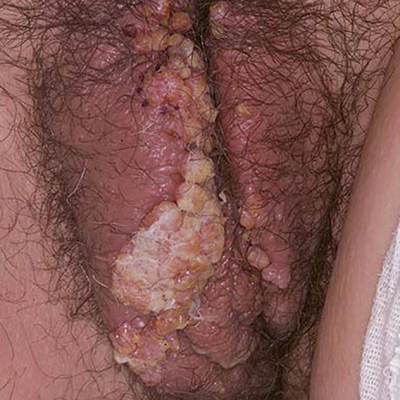 ویروس پاپیلومای انسانی (HPV) در زنان